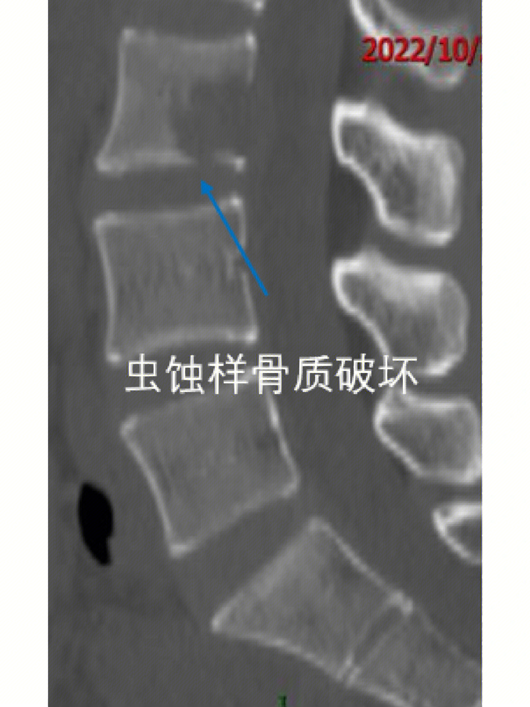 ct74l3椎体后下部可见溶骨性骨质破坏区并软组织肿块影,骨质破坏