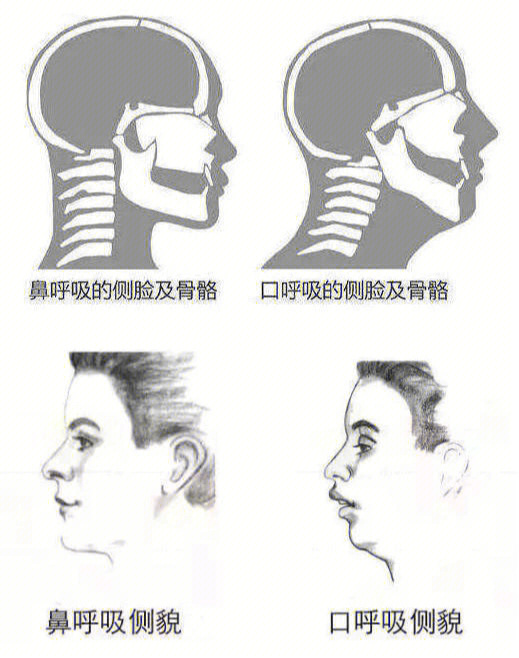 如何区分口呼吸和鼻呼吸