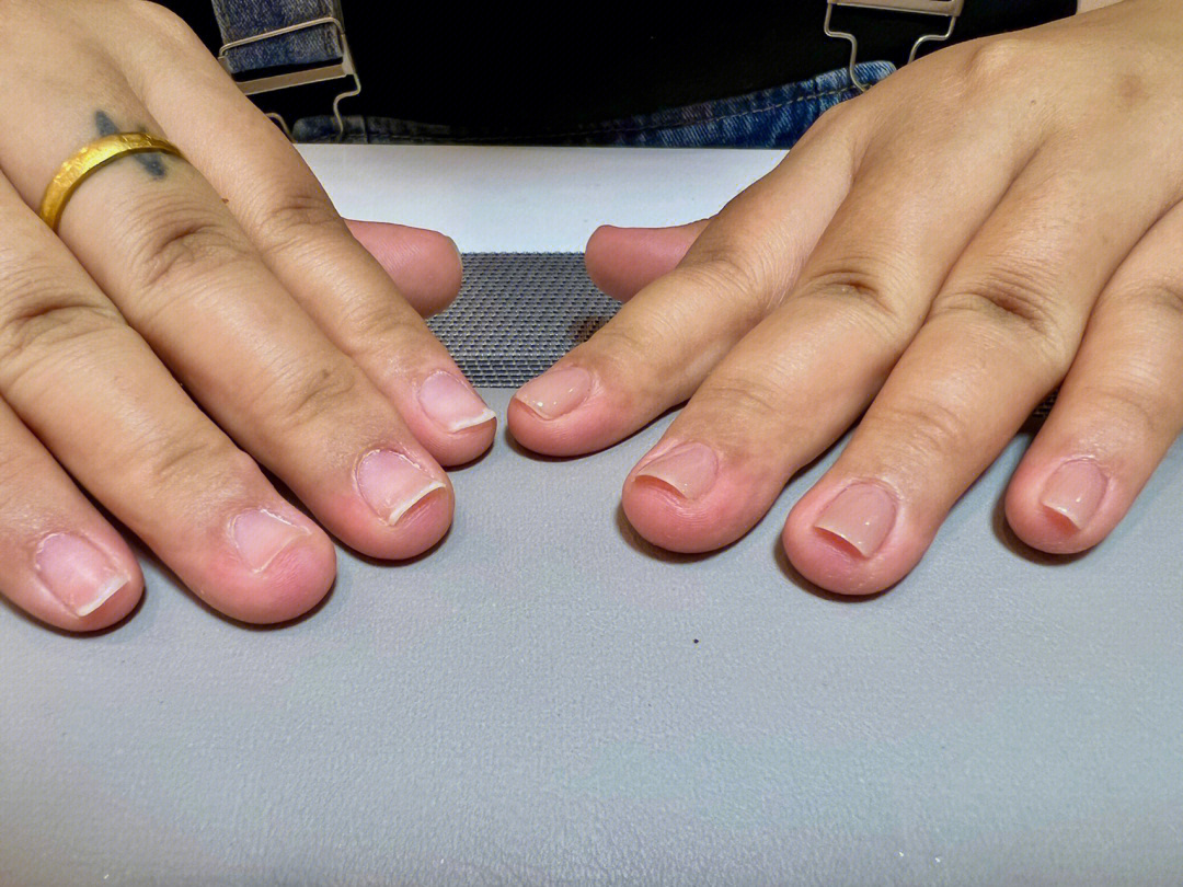 手指甲扁平是什么原因图片