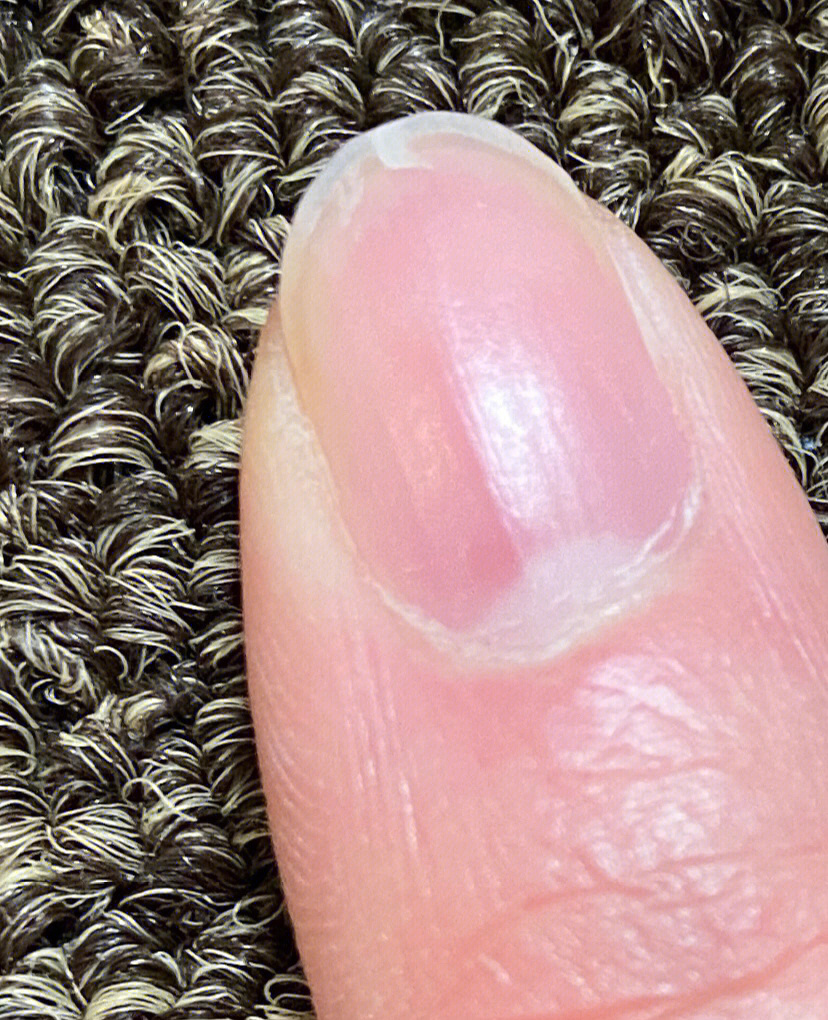 指甲缝裂开是什么原因图片