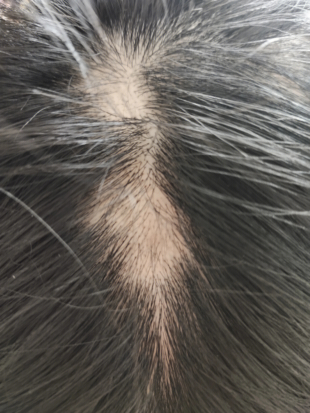 斑秃长头发的过程图片