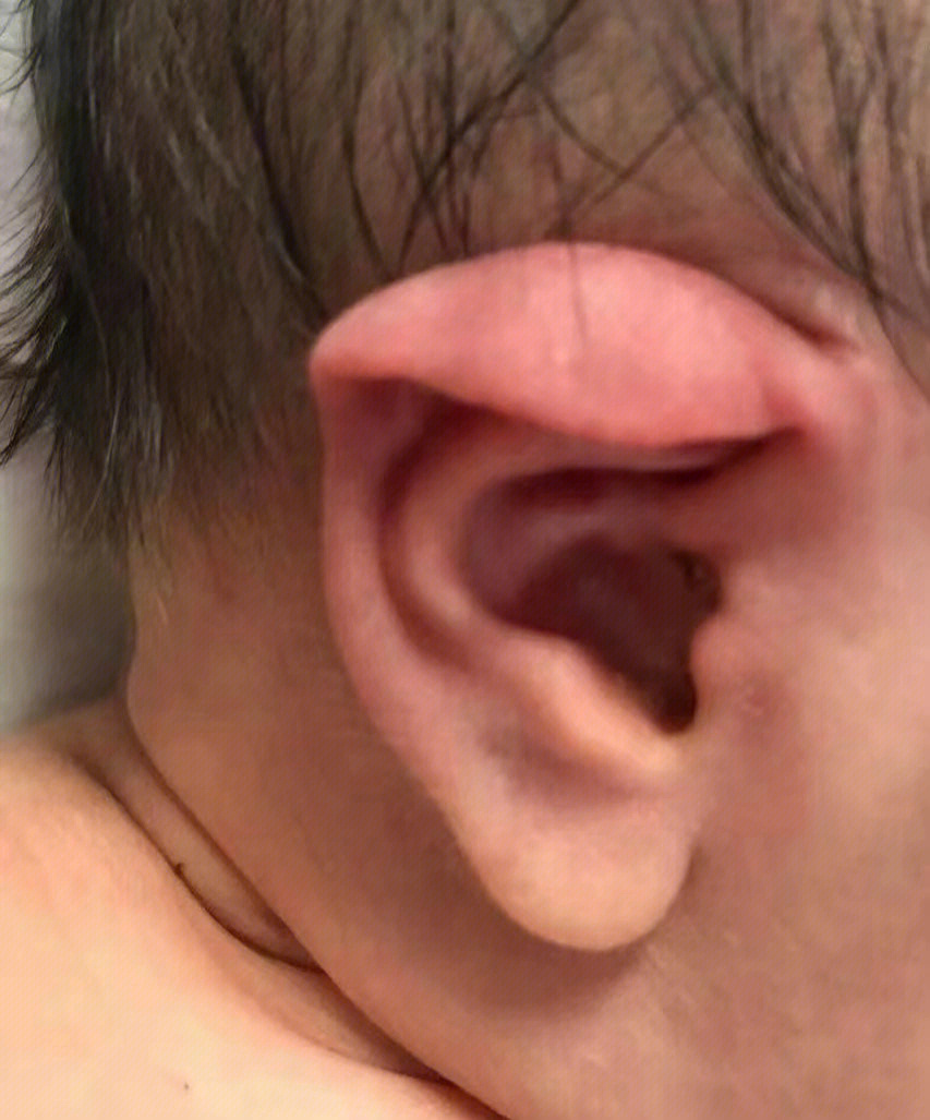 垂耳:耳轮自身折叠,耳廓高点下降