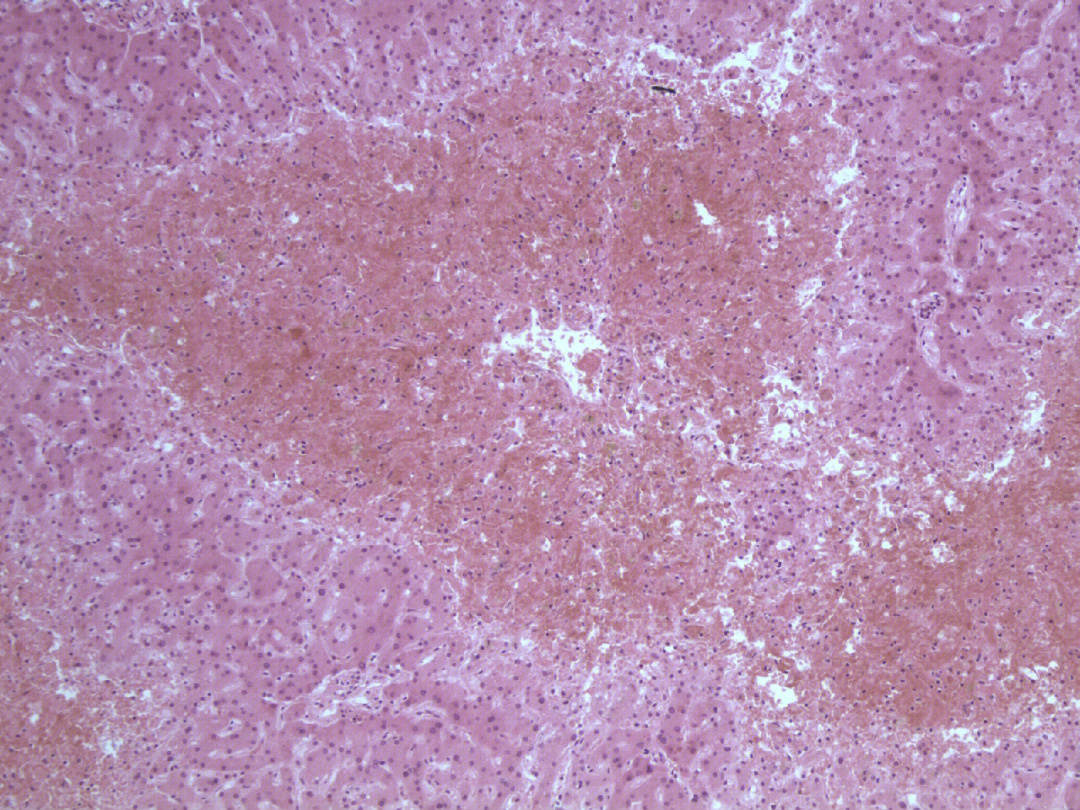 慢性肺淤血大体标本图片