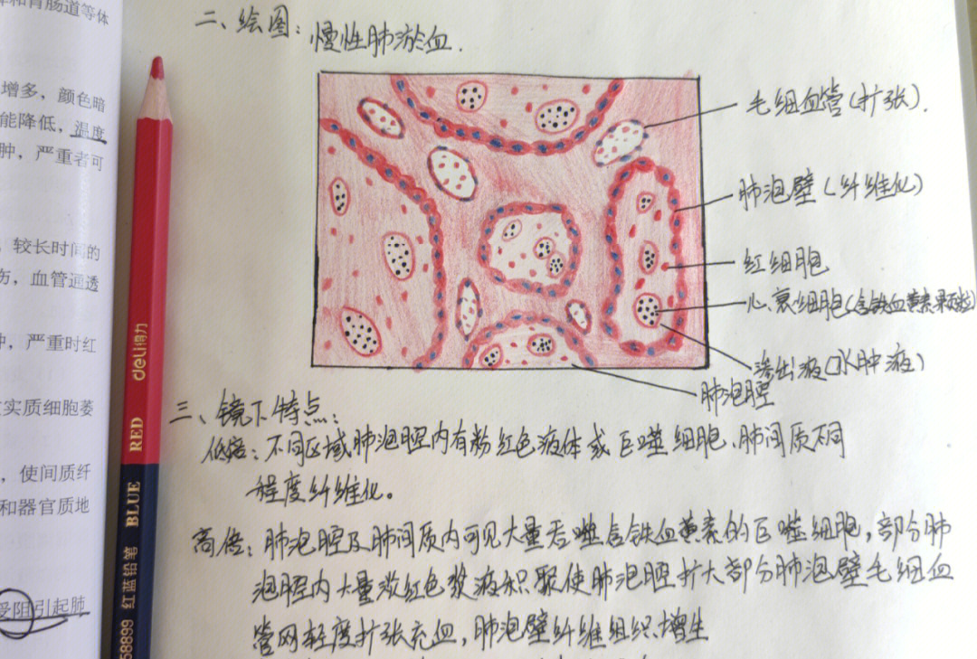 肾脓肿红蓝铅笔图图片