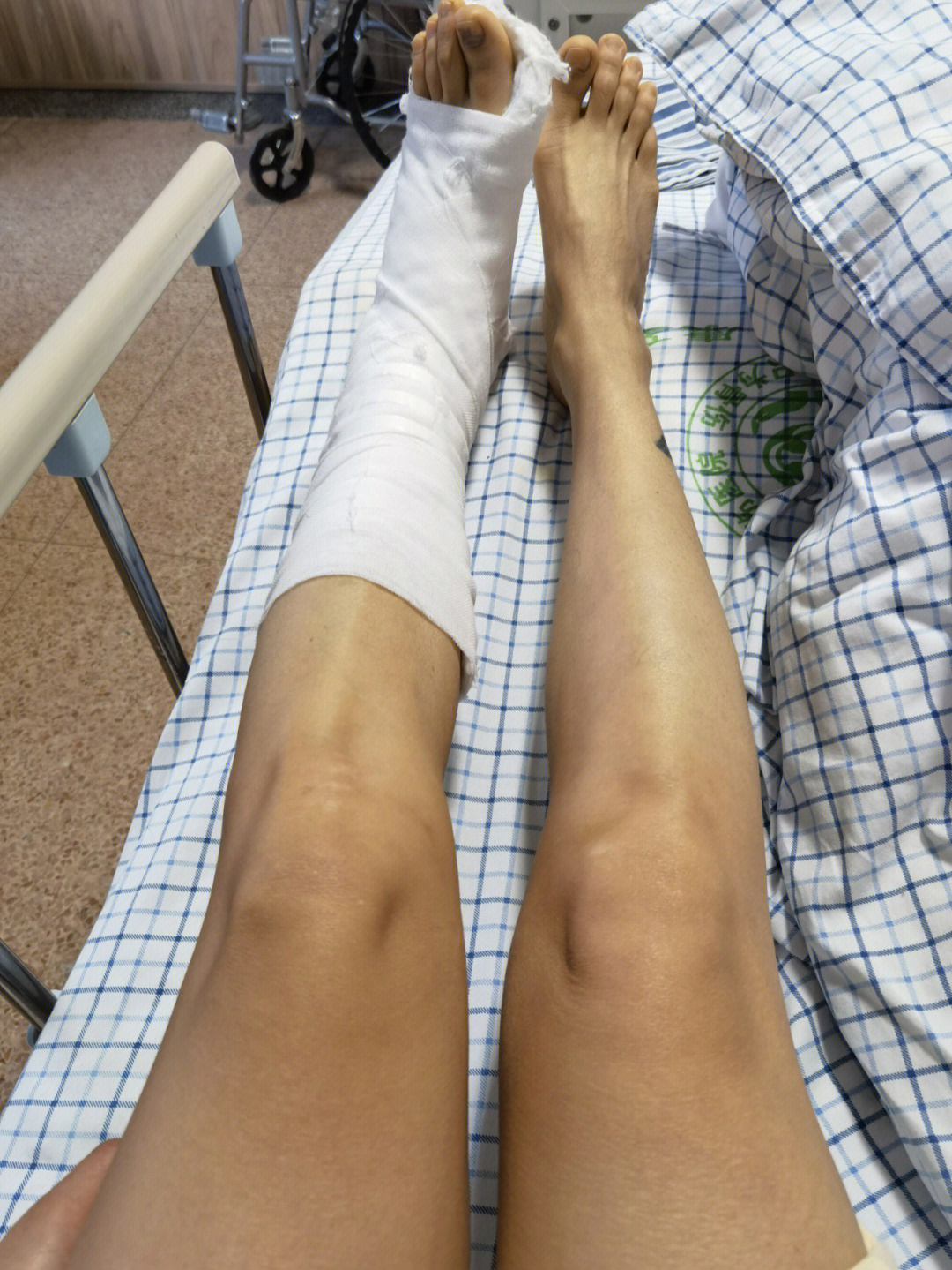 左脚踝骨折保守治疗第12天