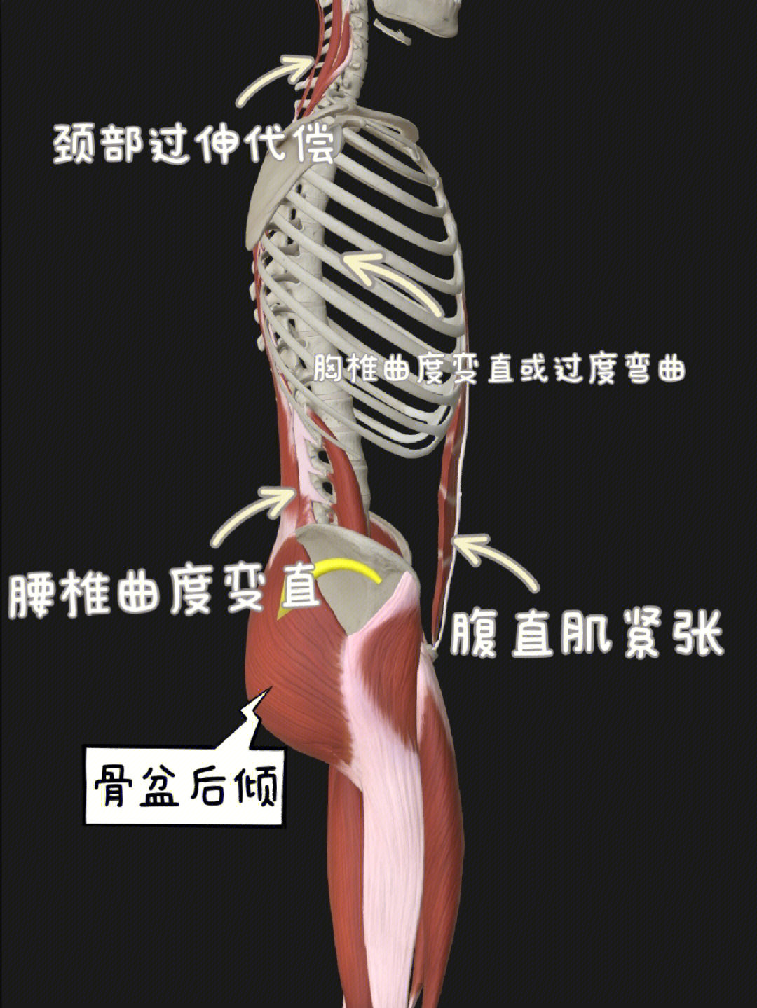 腘肌腱解剖图片