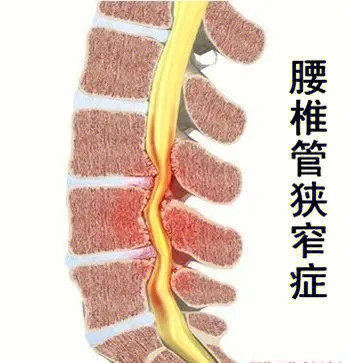 人体腰椎管狭窄示意图图片
