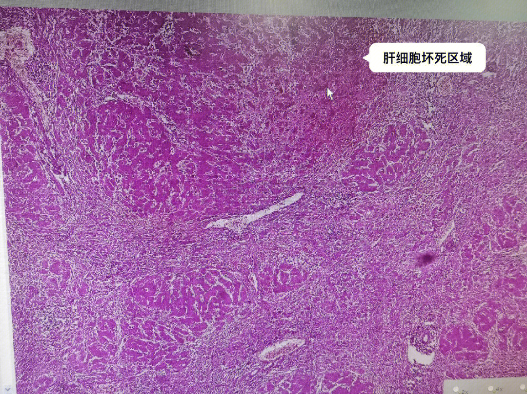 这张切片是一张急性肝炎患者的he染色切片(he染色:是一种由碱性染液