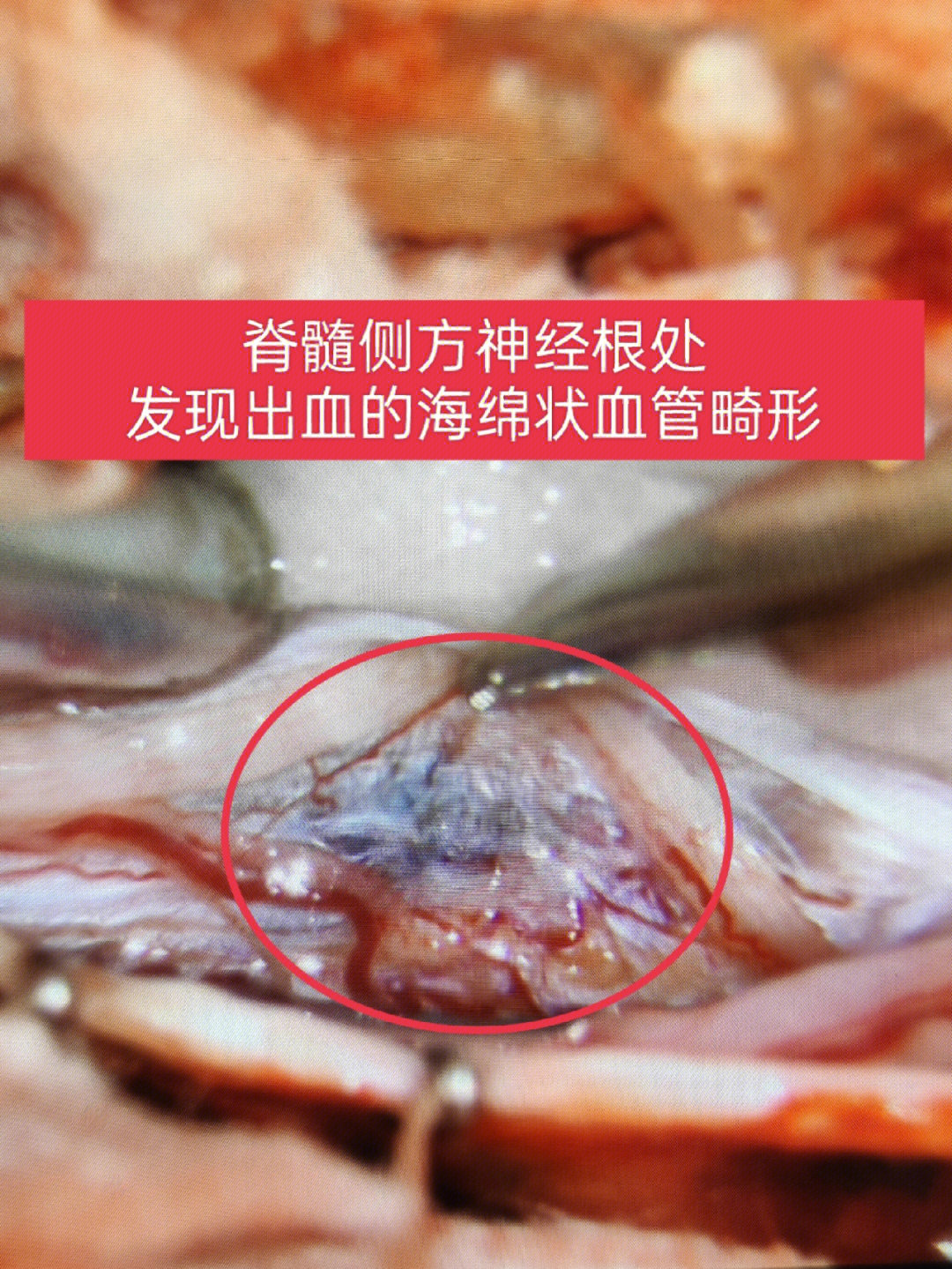 腹腔血管畸形图片