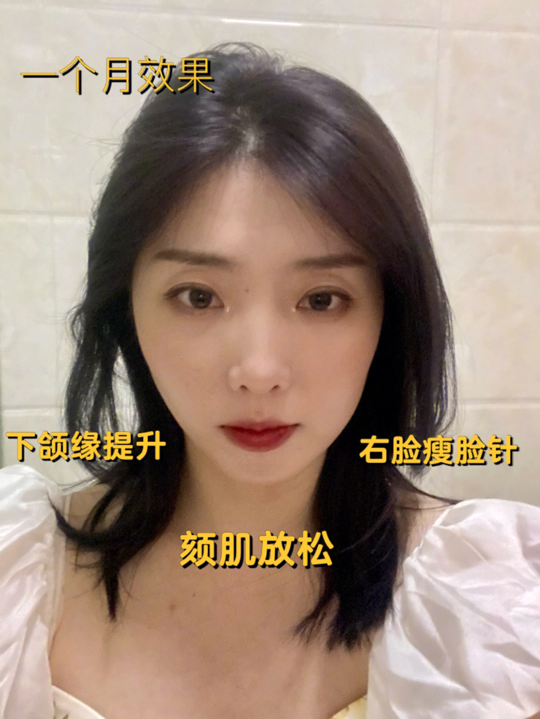 一个月:上海九院瘦脸针&下颌缘提升术后反馈