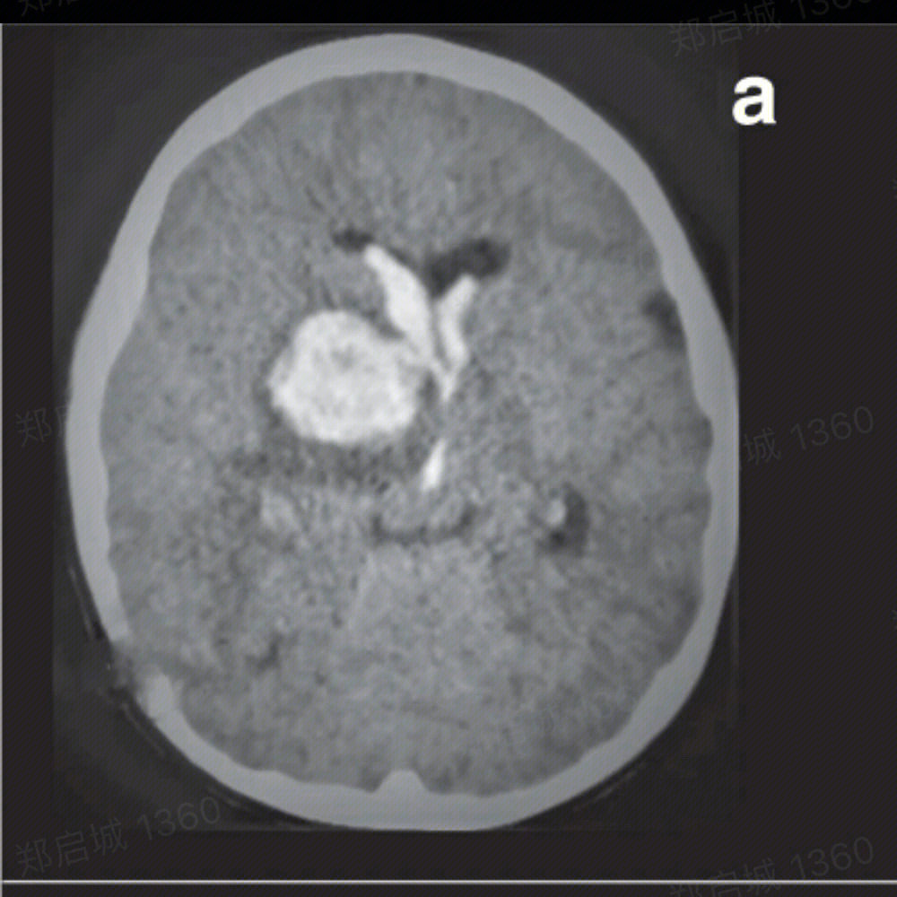 小脑幕出血图片