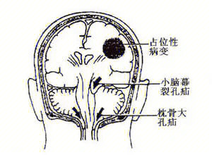 脑疝解剖&生理1小脑幕切迹,枕骨大孔2