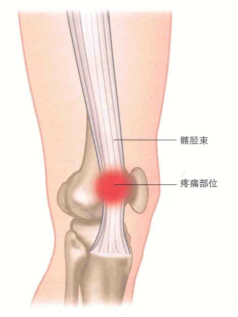 运动康复臀肌运动功能障碍