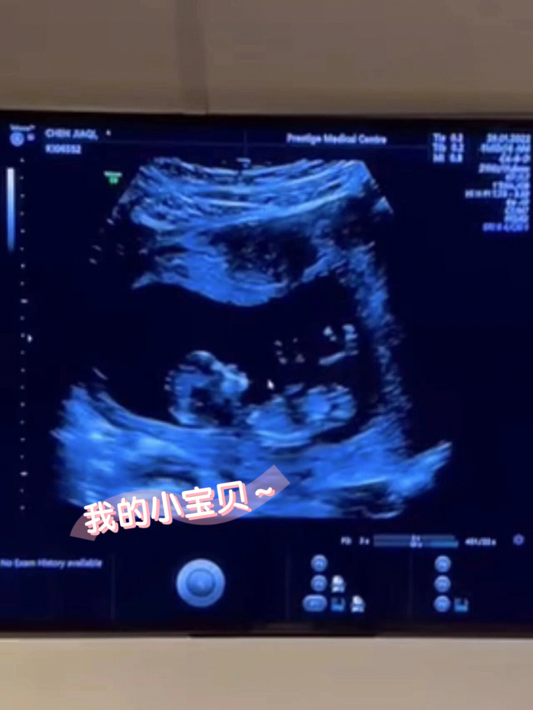 怀孕83天胎儿真实图片图片