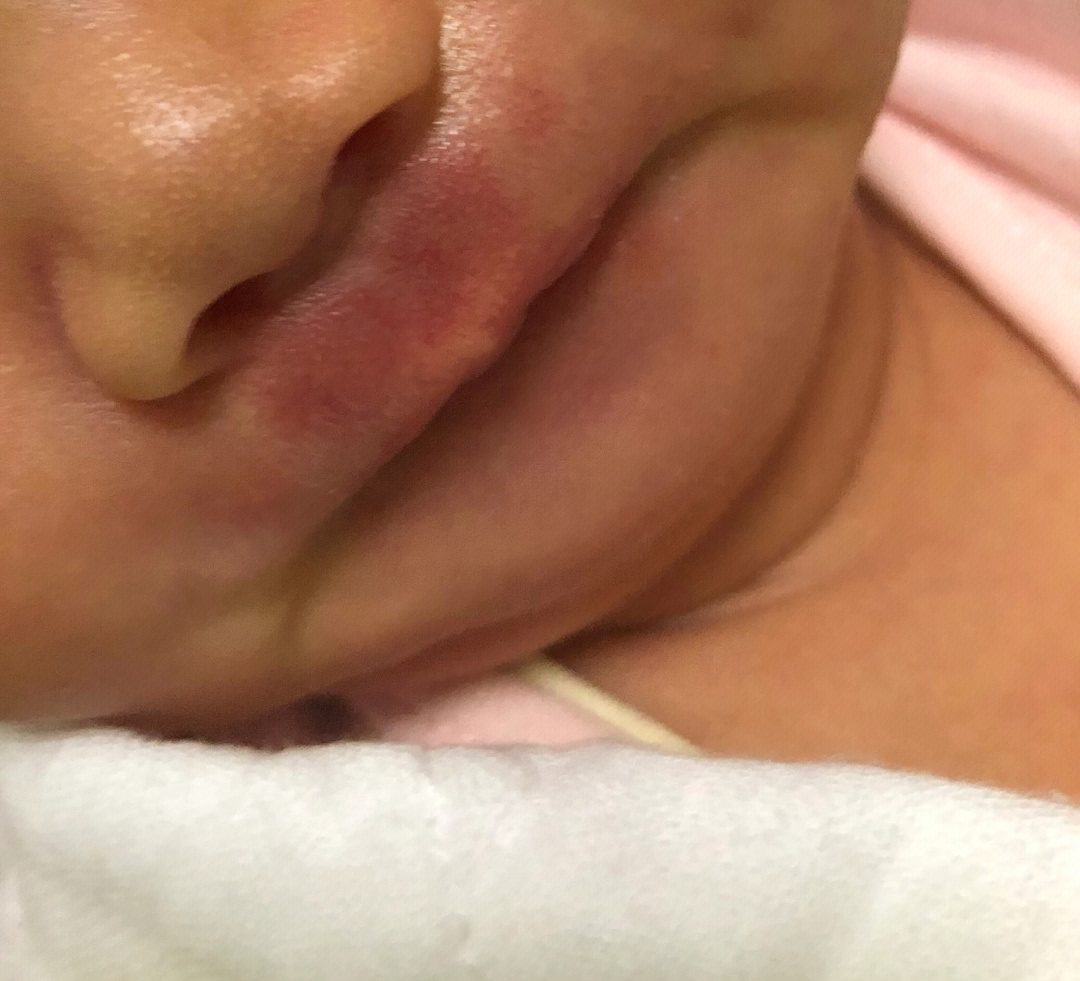 婴儿鼻子上有血管瘤图片