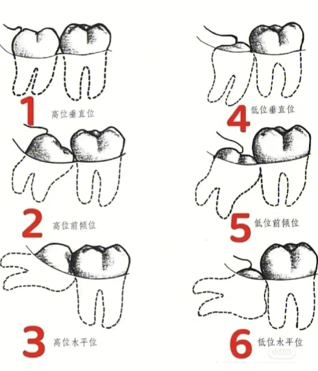 拔智齿难易程度排序图片