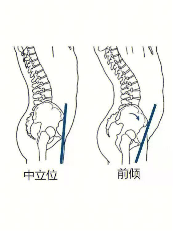 男性骨盆前倾图片