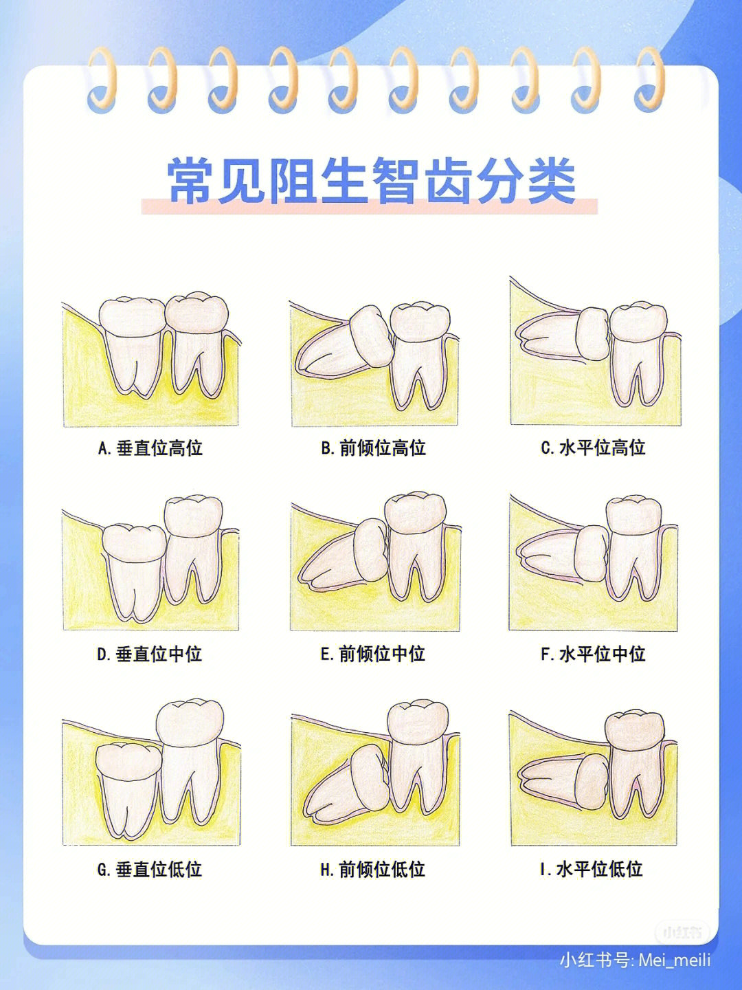 阻生牙的分类图片图片