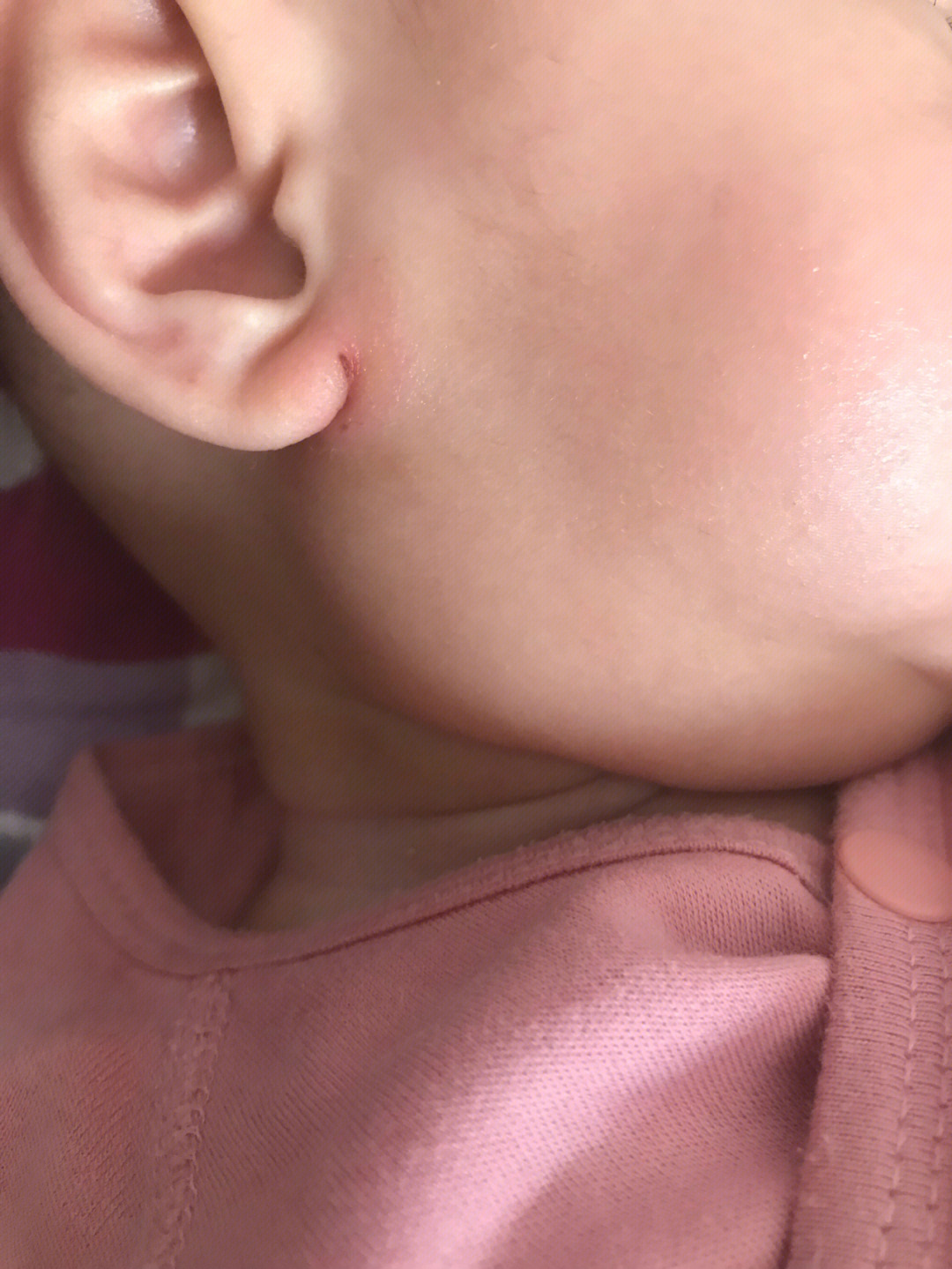 小孩耳朵根裂口图片图片