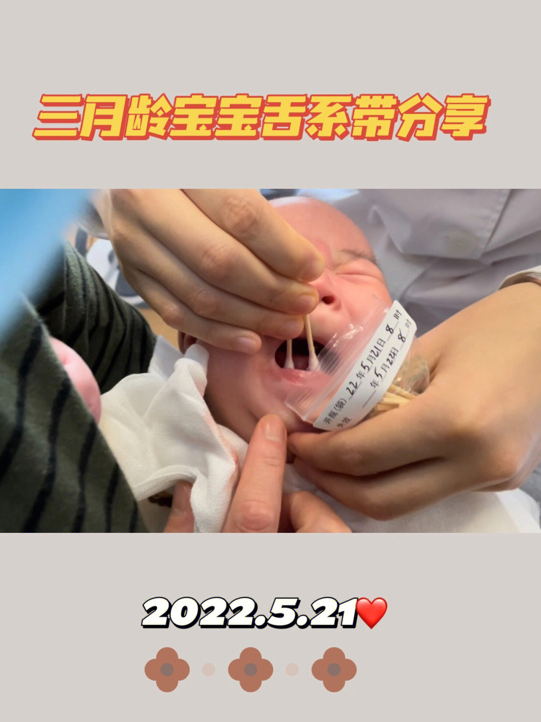 宝宝舌系带溃疡图片