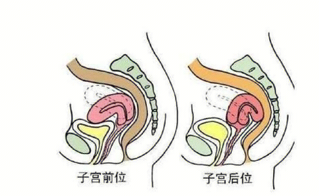 子宫后位压迫直肠图图片