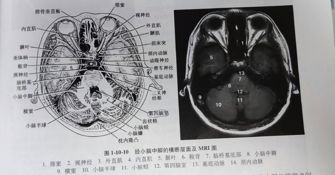 额窦横断面图片