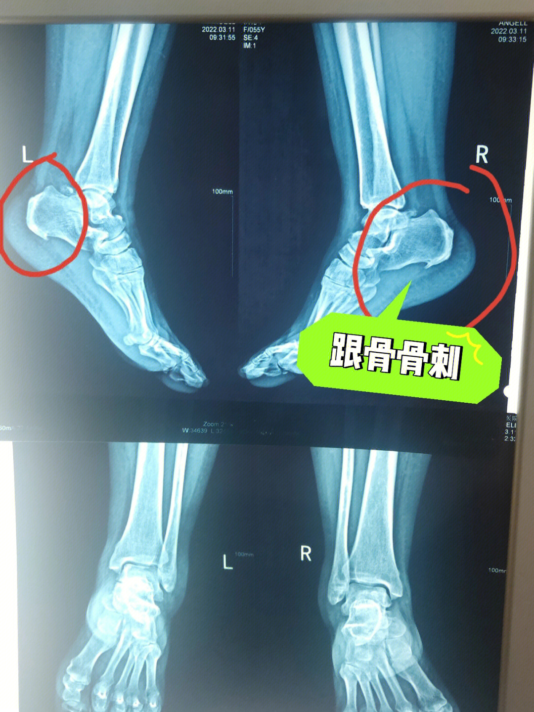 跟骨骨刺针刀动画演示图片