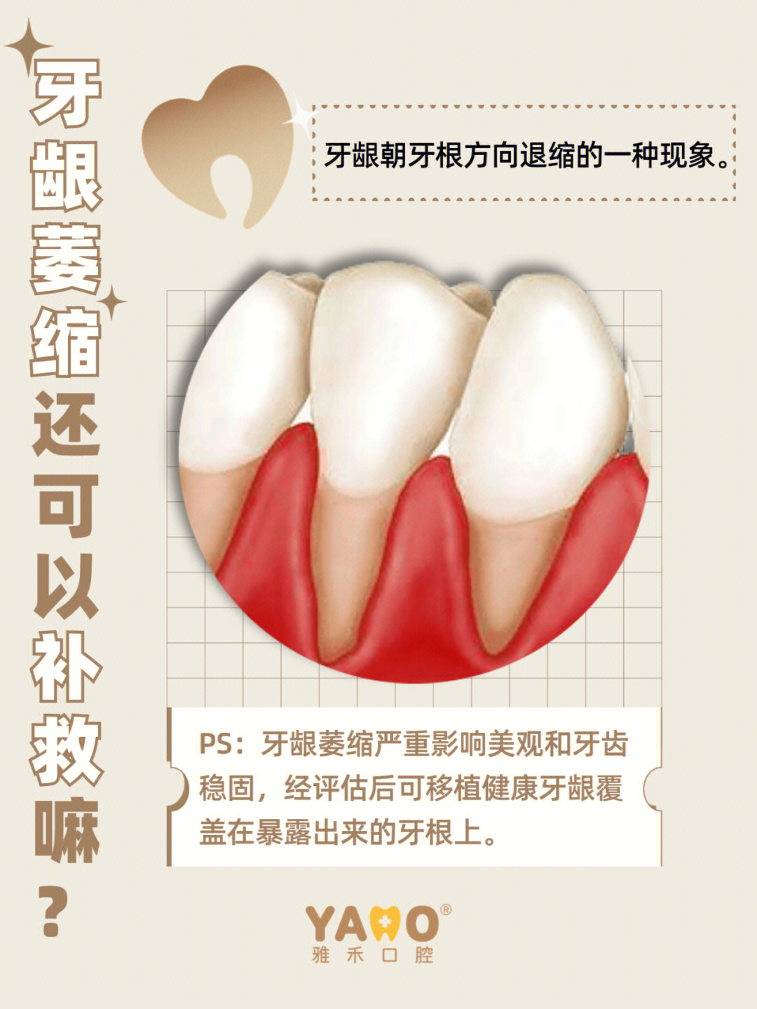 牙龈萎缩怎么恢复图片