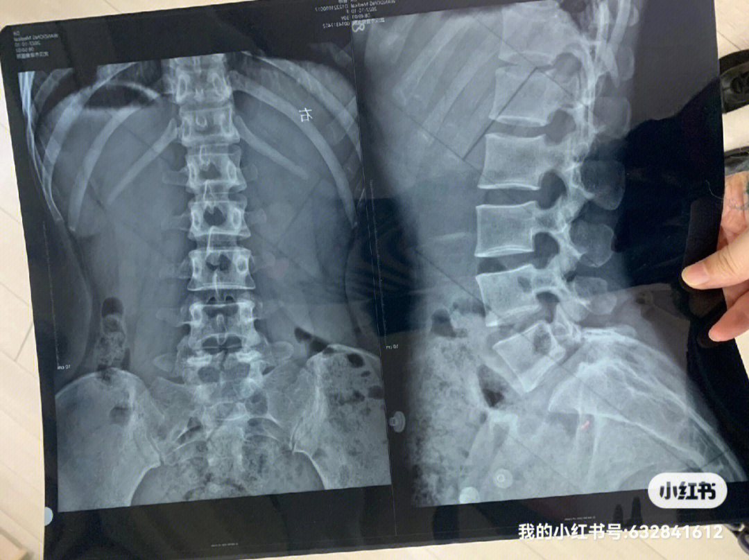 颈椎椎弓峡部裂图片图片