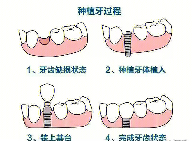 备牙的基本步骤图解图片