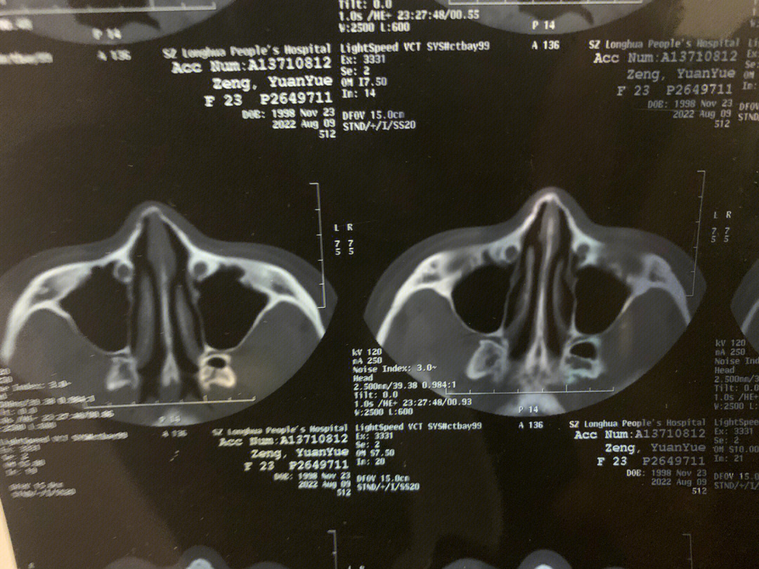 鼻骨骨折 手术图片