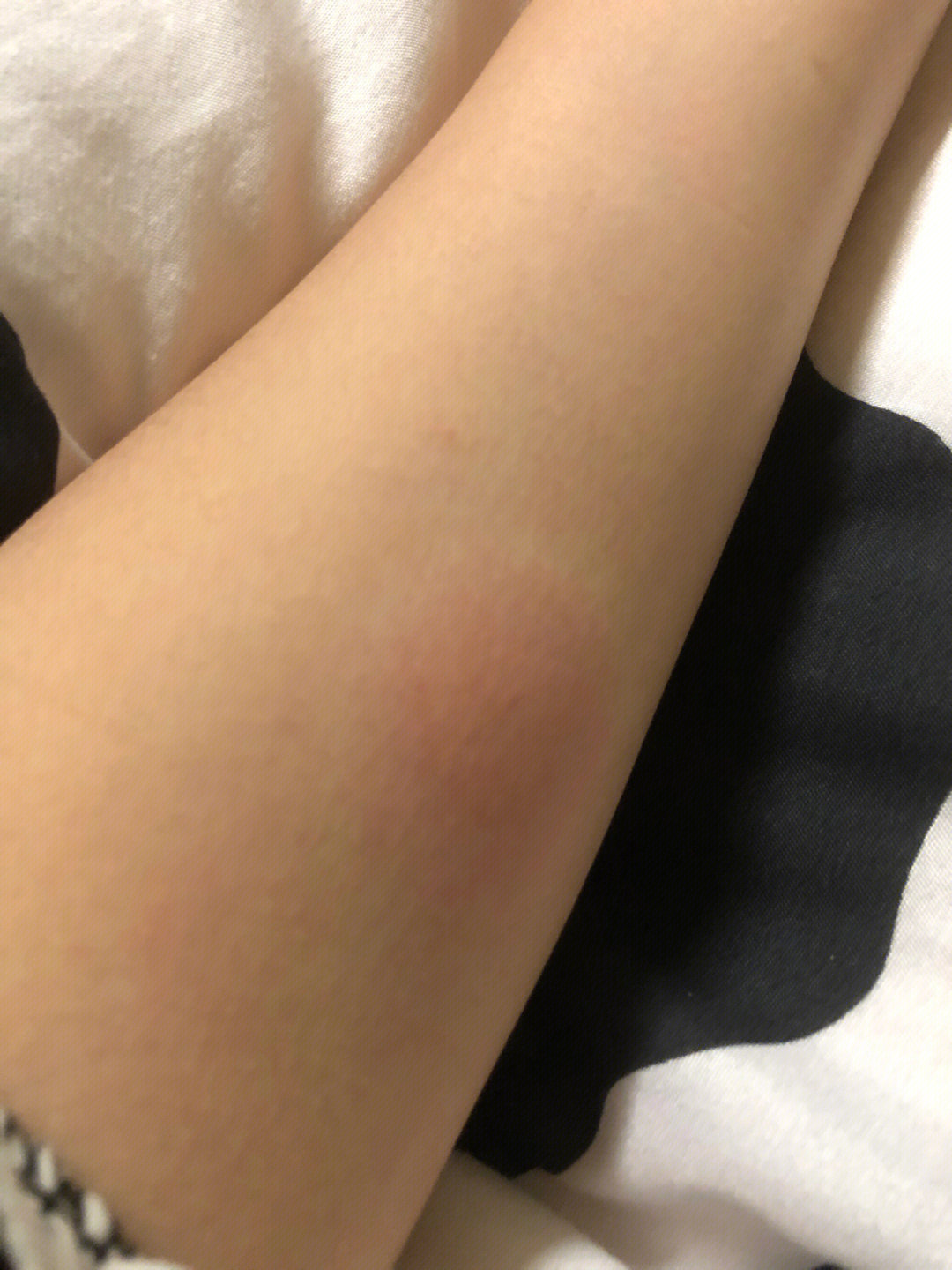 肺结核ppd