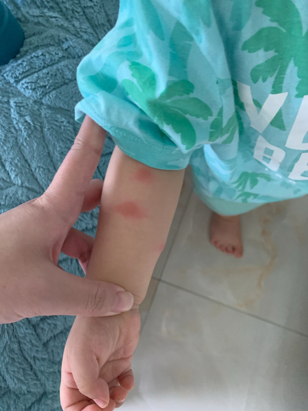 宝宝被毒蚊子咬了图片图片