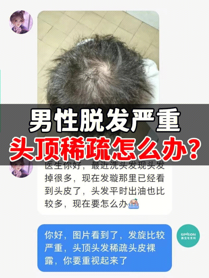 男性脱发严重头顶稀疏怎么办