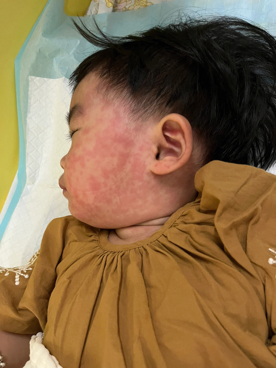幼儿急疹的症状及治疗图片