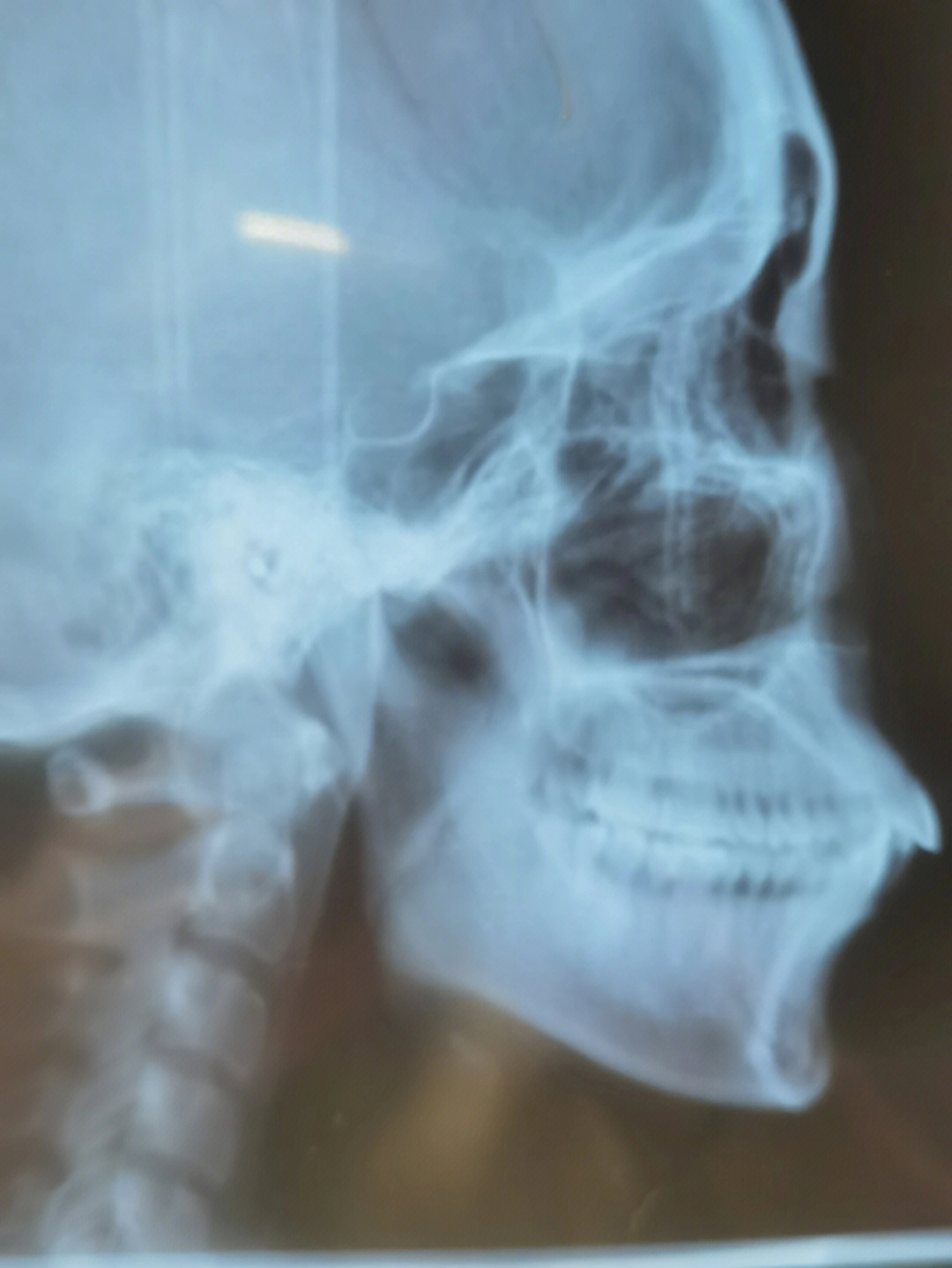 骨性嘴凸x光图片