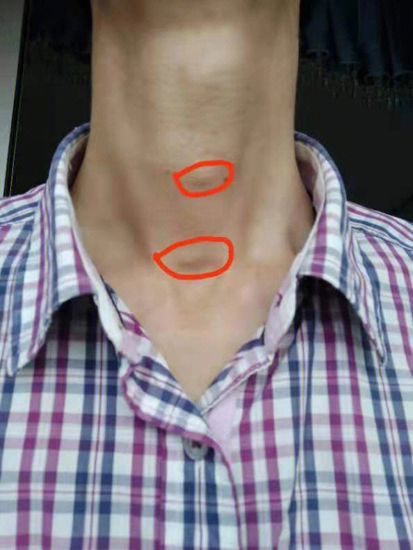 右侧甲状腺结节图片