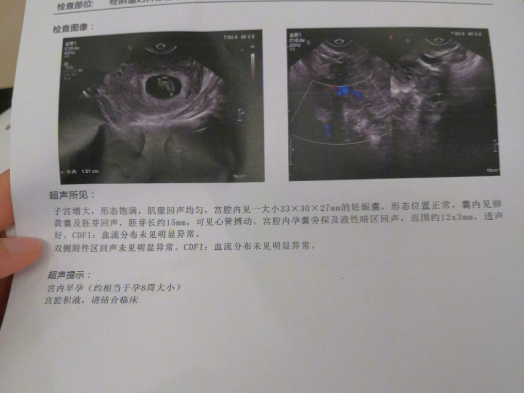 羊膜囊下积液排出图片图片