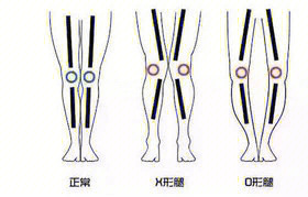 x型腿走路图解图片