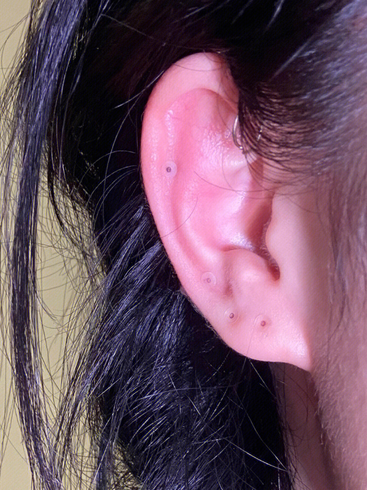 耳朵一直发炎过敏流脓各种不舒服,需要养耳洞期间耳钉材质一定要选择