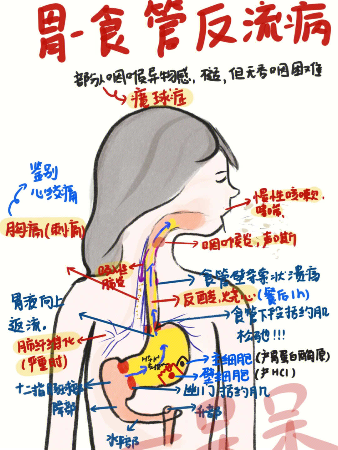 胃食管反流图解图片