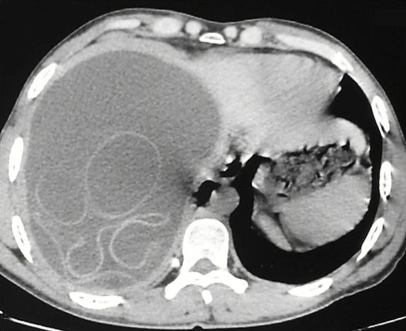 肺棘球蚴病图片