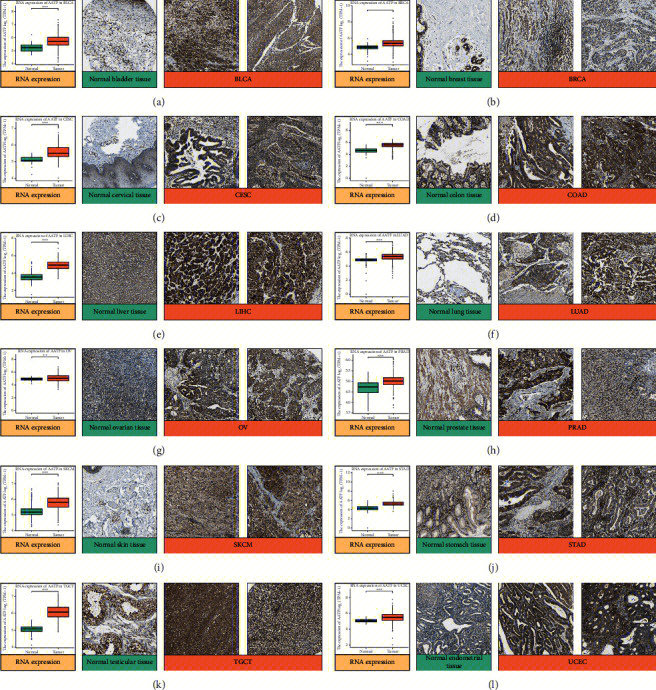 the oncogenic and immunological roles of apoptosis antagonistic