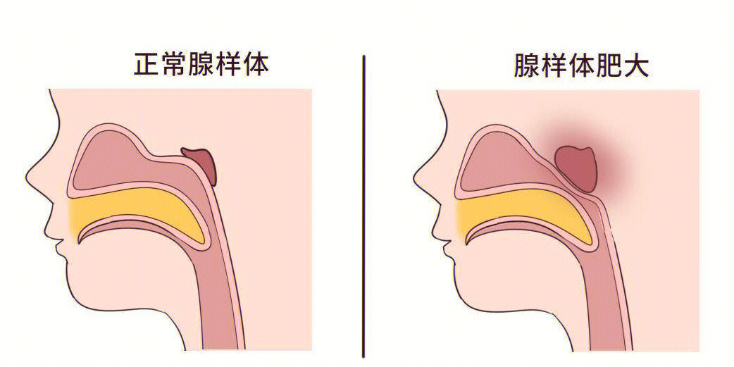 腺样体肥大有哪些症状