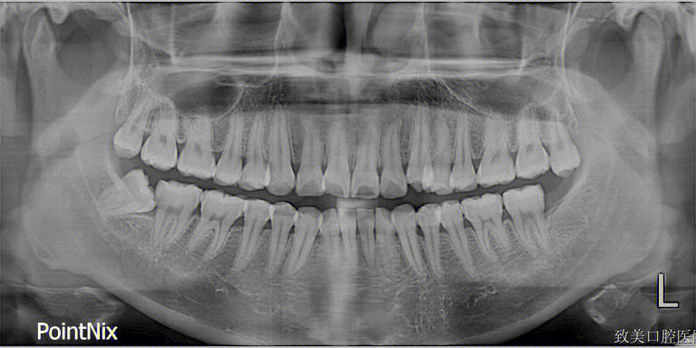 牙槽骨骨刺照片图片