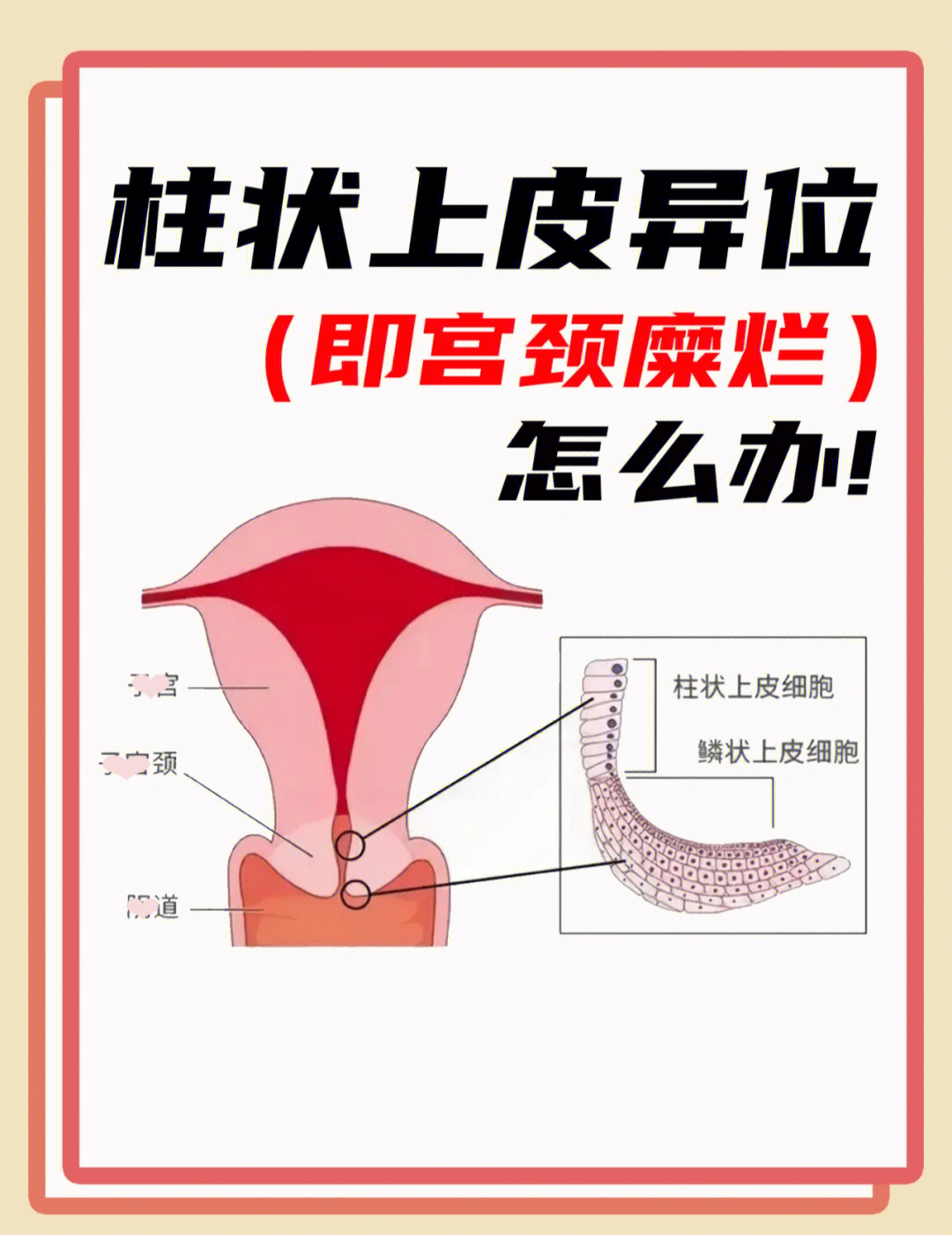 轻度宫颈糜烂怎么治疗图片