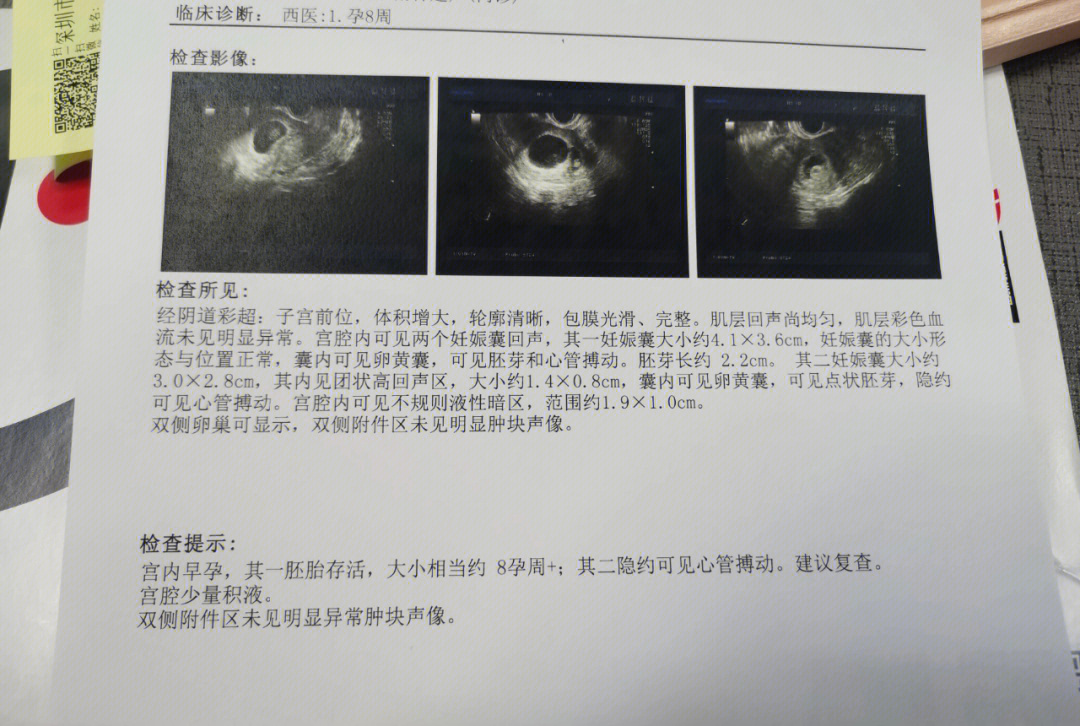 孕囊大小对照表8周图片