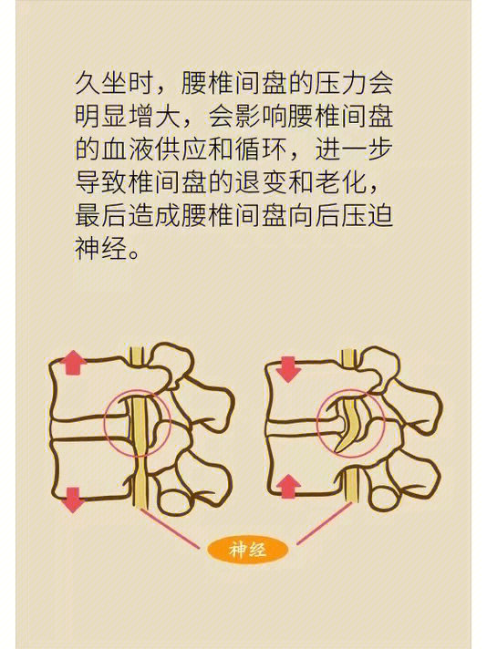 腰椎间盘突出症腰椎间盘突出症是什么