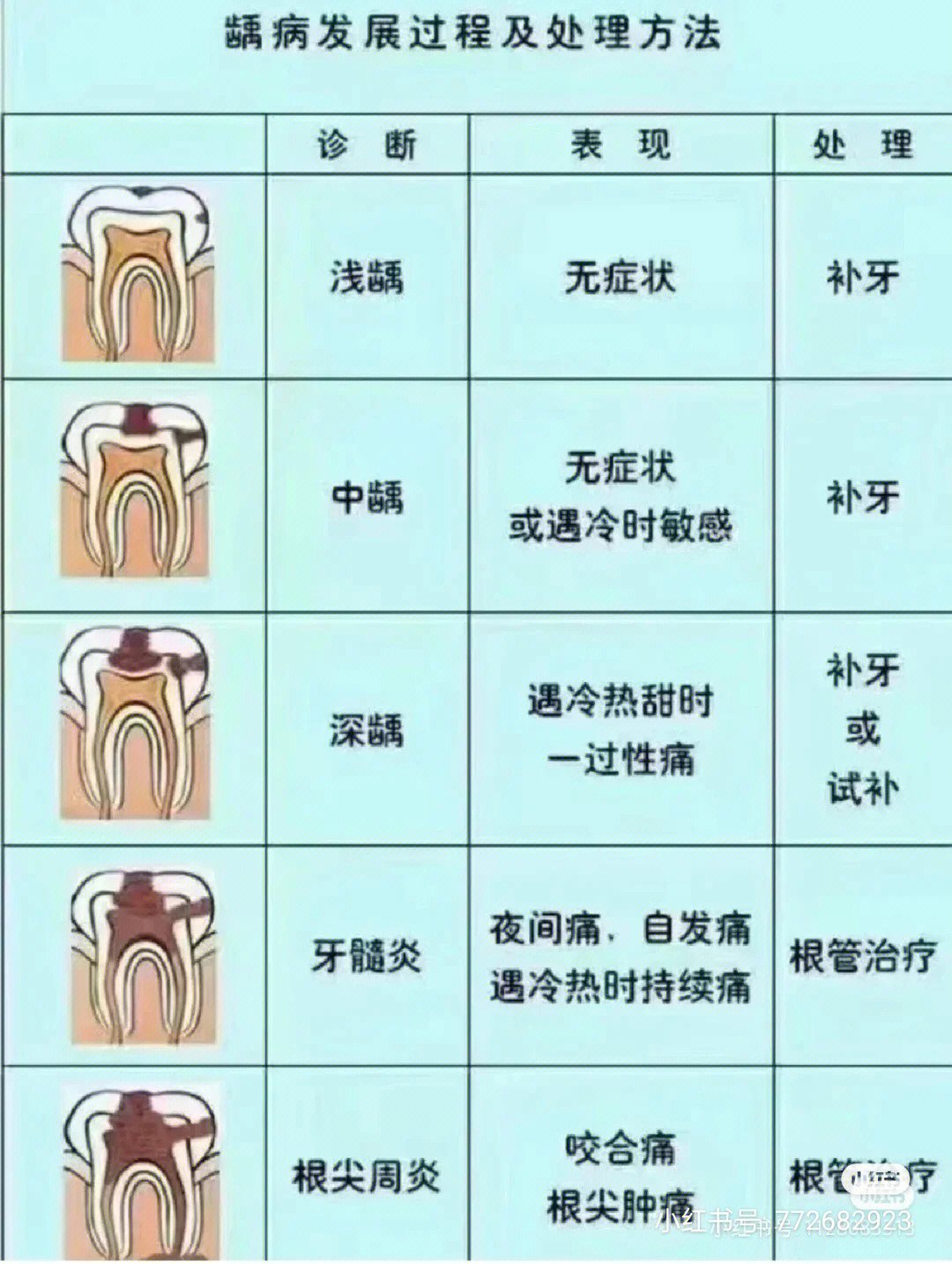 龋齿赶紧看否则越来越烧钱