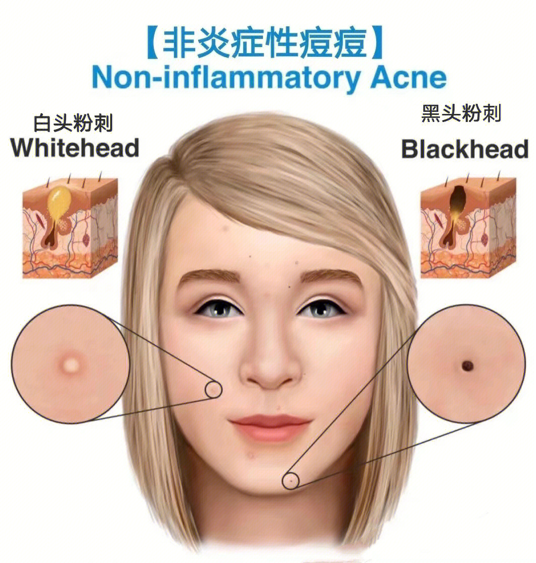 粉刺和黑头的区别图片图片